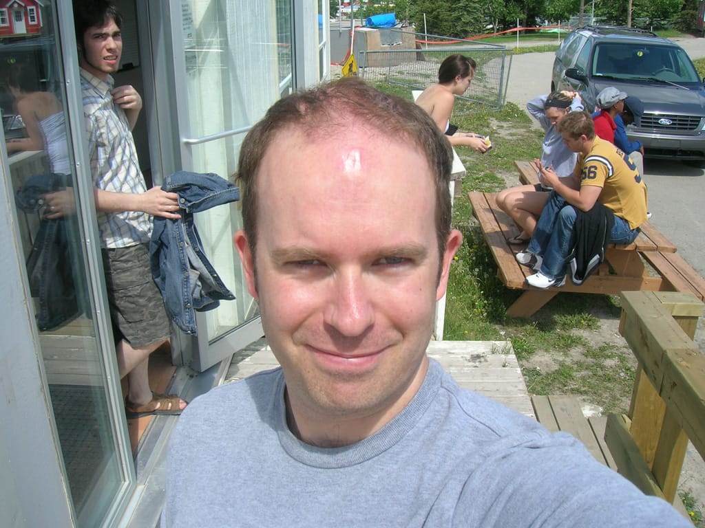 Mark on my head from impact, Canada Olympic Park, Calgary, Alberta, 8 June 2007