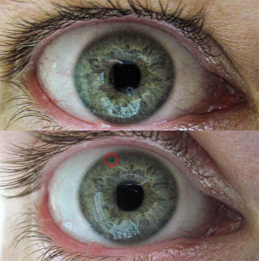 Right Yag Laser Iridotomy, Before and After